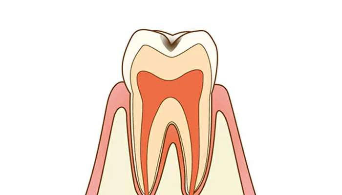 初期の虫歯:樹脂の詰め物で治療（C1:エナメル質う蝕）