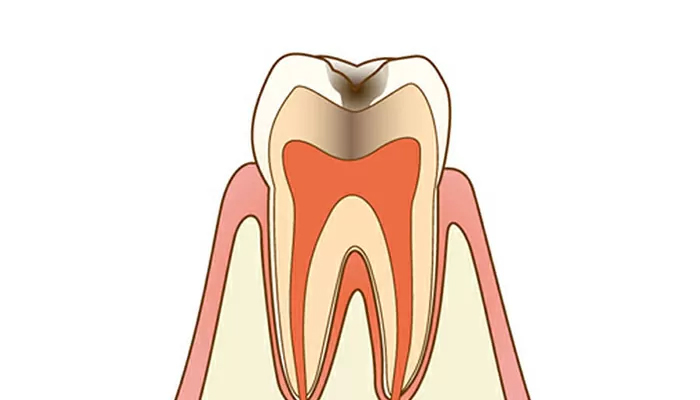 中度の虫歯:詰め物で治療（C2:象牙質う蝕）