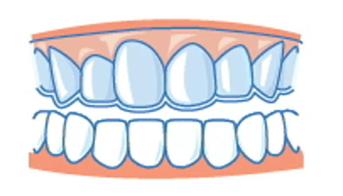 歯ぎしりの治療の流れ