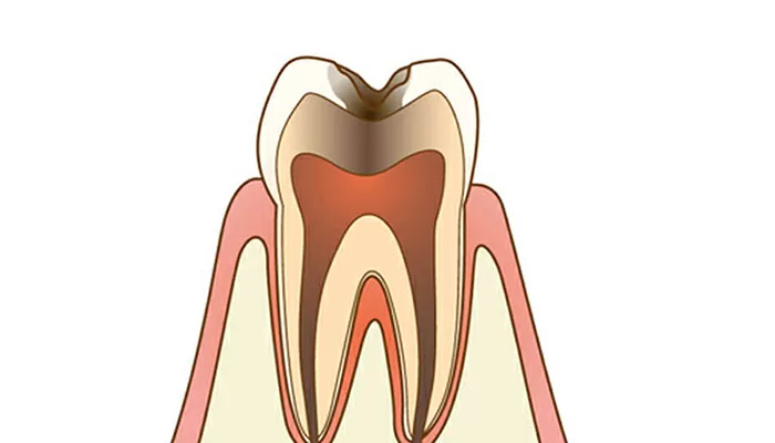 重度の虫歯:被せ物で治療（C3:神経まで達したう蝕）