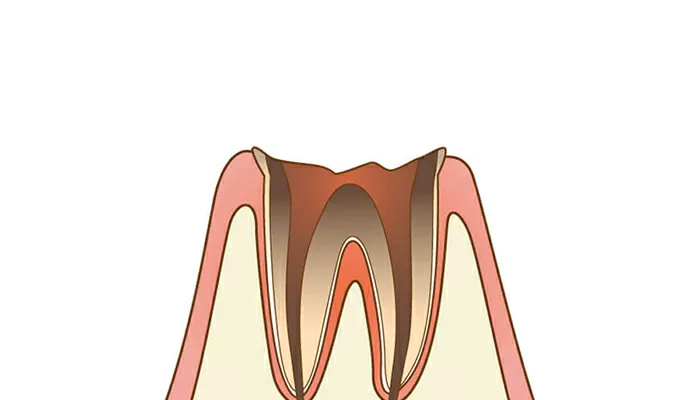 重重度の虫歯:被せ物で治療（C4:残根状態）